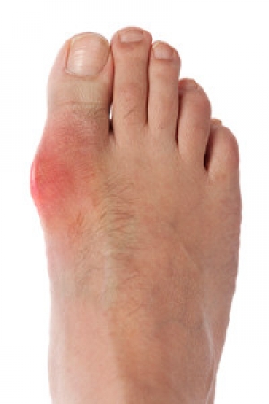 Causes and Symptoms of Gout