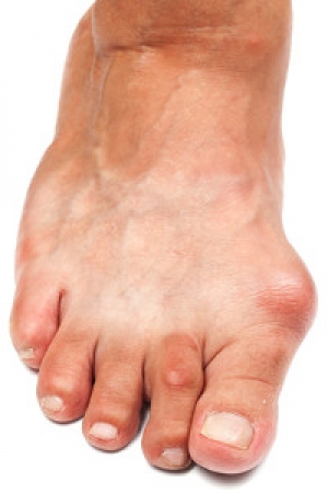 Bunion Therapy